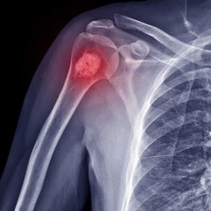 orthopedic oncology cost in india