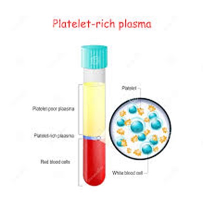 platelet rich plasma