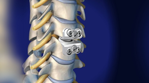 cervical disk replacement