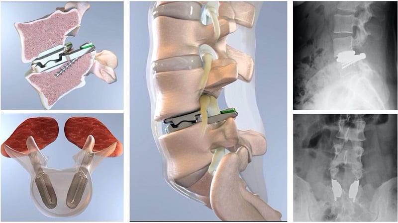 lumbar disk replacement