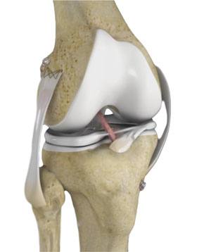 ligament reconstruction