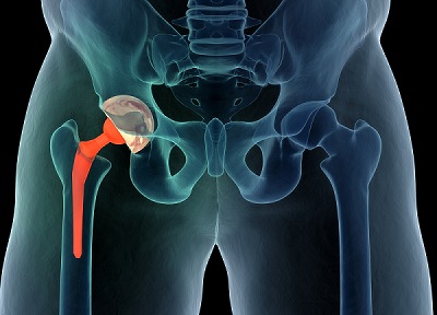 hip replacement